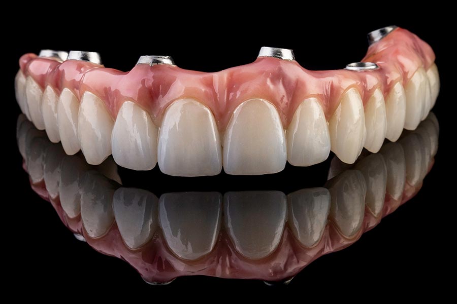 Leistungen Implantat Zahnarzt - Thiele Dental-Technik GmbH